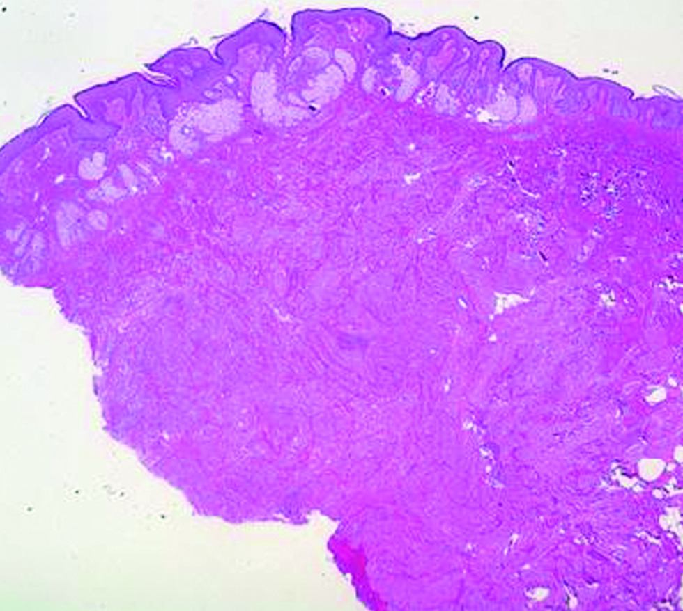 Large numbers of mature sebaceous glands and dermal tumour nests visible in the dermis. (Hematoxylin and eosin, ×20)