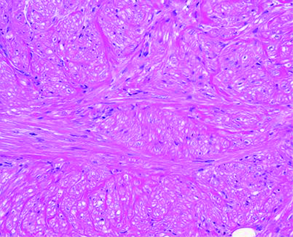 The dermal tumour cells with a spindle-shaped morphology (Haematoxylin and eosin, ×200)