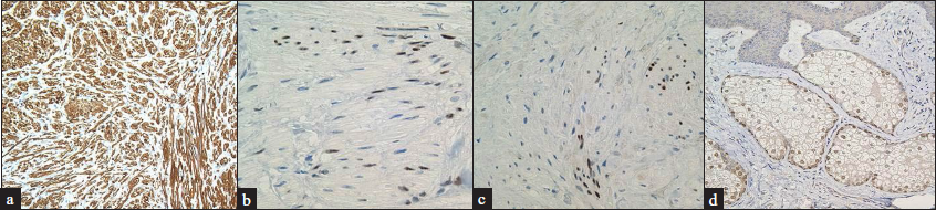 The dermal tumour cells showing positive staining for (a) α-smooth muscle actin (×200), (b) estrogen receptors (×400) and (c) progesterone receptors (×400); (d) Proliferated sebocytes testing positive for androgen receptors (×200)