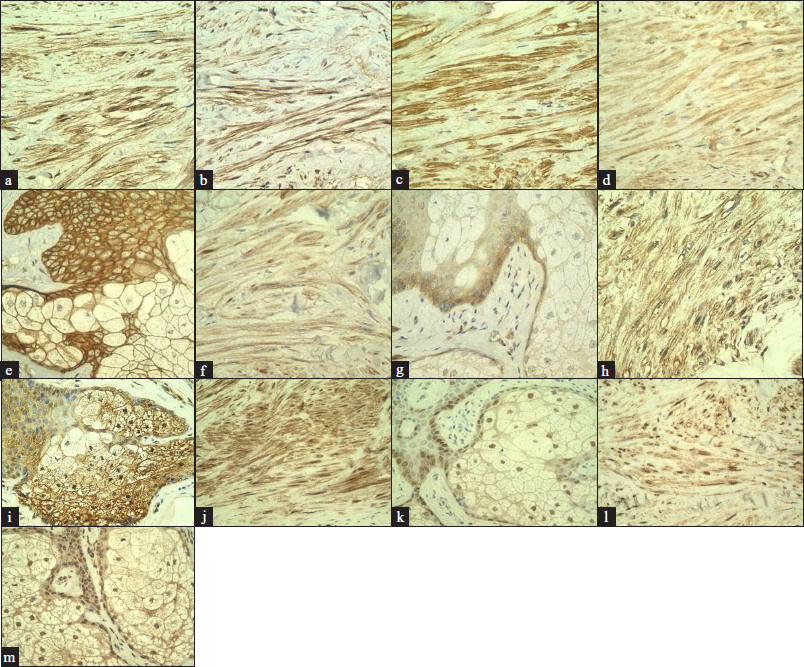 High expression in the leiomyoma displayed by (a) epidermal growth factor (×400), (b) insulin-like growth factor-1 (×400) and (c) fibroblast growth factor-2 (×400); (d) Epidermal growth factor receptor showing expression in the leiomyoma (×400), (e) Epidermal growth factor receptor showing expression in the sebocytes with the adjacent keratinocytes (×400), (f) Insulin-like growth factor-1 receptor β showing expression in the leiomyoma (×400), (g) Insulin-like growth factor-1 receptor β showing expression in the sebocytes with the adjacent keratinocytes (×400), (h) Fibroblast growth factor receptor 2 showing expression in the leiomyoma (×400), (i) Fibroblast growth factor receptor 2 showing expression in the sebocytes with the adjacent keratinocytes (×400), (j) Positive staining of phosphorylated extracellular signal-regulated kinase 1/2 in the leiomyoma (×400), (k) Positive staining of phosphorylated extracellular signal-regulated kinase 1/2 in the sebocytes with adjacent keratinocytes (×400), (l) Positive staining of phosphorylated Akt in the leiomyoma (×400), (m) Positive staining of phosphorylated Akt in the sebocytes with adjacent keratinocytes (×400).