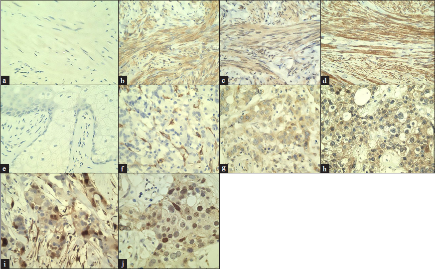 (a) Negative control staining in the leiomyoma using rabbit IgG isotype control antibody (×400); Positive control staining using a uterine leiomyoma sample for: (b) epidermal growth factor (×400), (c) insulin-like growth factor-1 (×400), (d) fibroblast growth factor-2 (×400), (e) Negative control staining in the sebocytes with adjacent keratinocytes using rabbit IgG isotype control antibody (×400); Positive control staining using a breast cancer sample for: (f) epidermal growth factor receptor (×400), (g) insulin-like growth factor-1 receptor β (×400), (h) fibroblast growth factor receptor 2 (×400), (i) phosphorylated extracellular signal-regulated kinase 1/2 (×400) and (j) phosphorylated Akt (×400)