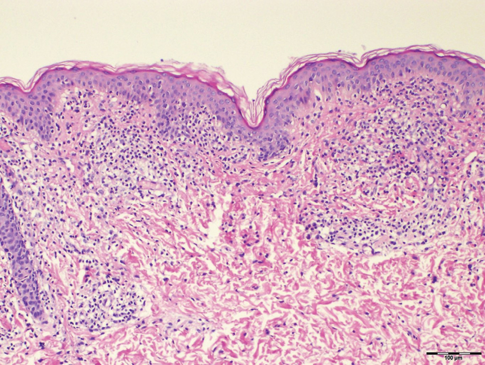 Band-like dermal lymphoid infiltration (hematoxylin and eosin, ×40)