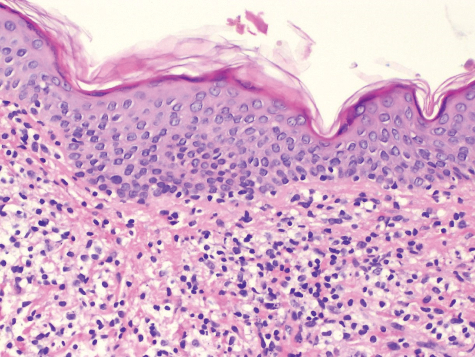 Intraepidermal lymphocytes tagging at the dermo-epidermal junction (hematoxylin and eosin, ×100)