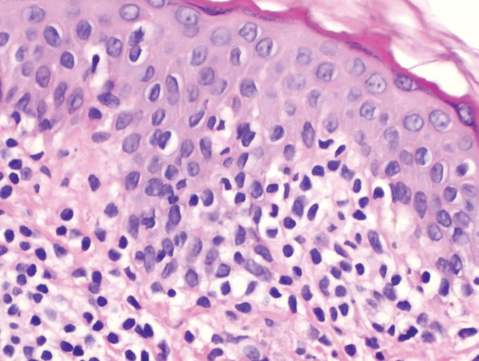 Intraepidermal lymphocytes showing variable nuclear pleomorphism with perinuclear haloes (hematoxylin and eosin, ×200)