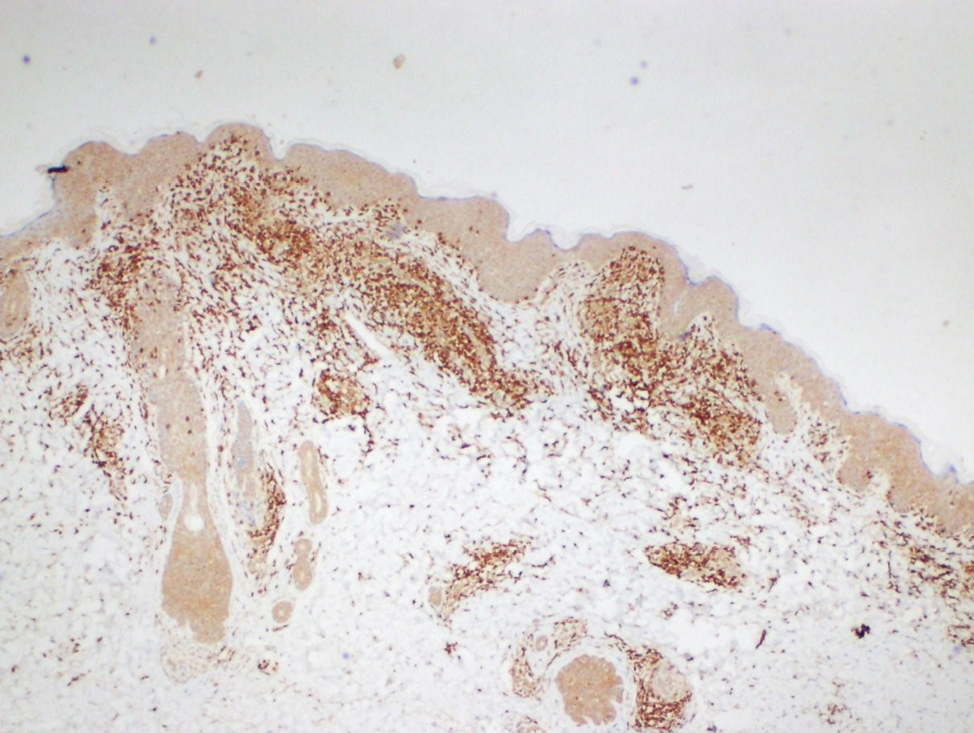 The lymphocytes immunohistochemically express CD3 which is pan T marker (Diaminobenzidine, ×40)