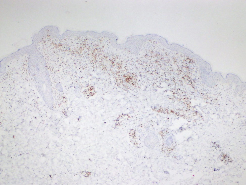 Focal loss of CD7 expression (Diaminobenzidine, ×40)