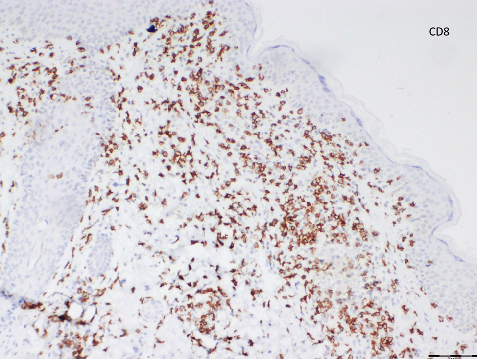 The lymphocytes more profoundly express CD8 expression than CD4 expression (Diaminobenzidine, ×100)