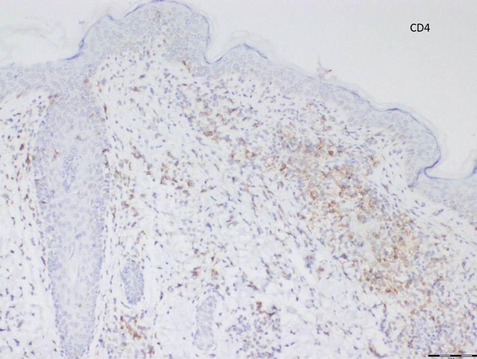 The lymphocytes more profoundly express CD8 expression than CD4 expression (Diaminobenzidine, ×100)