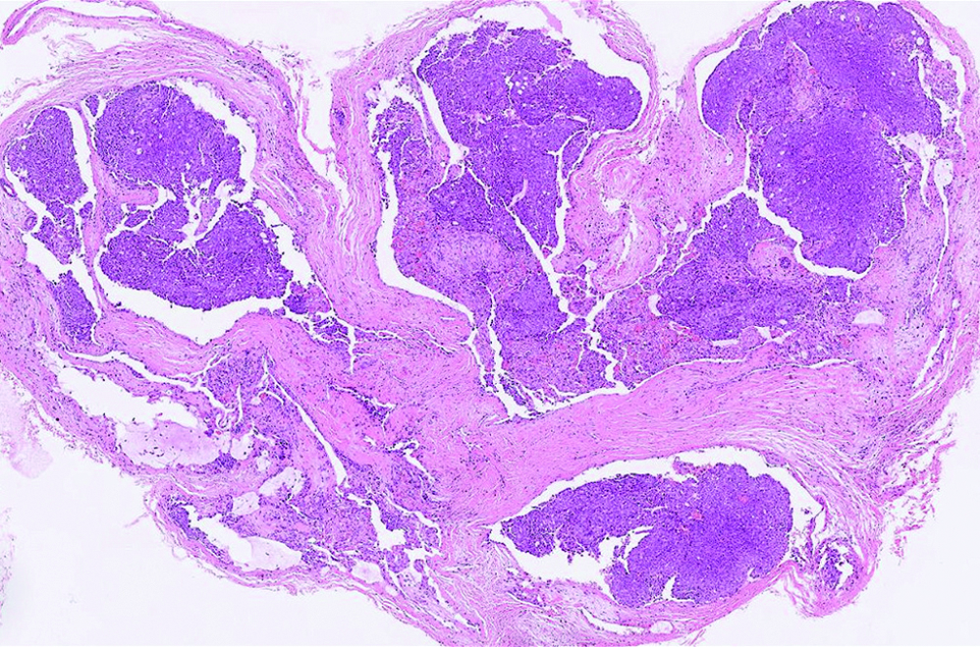 The multinodular tumour with solid, cribriform and vague papillary architectures, with peripheral artifactual spaces in the first case (hematoxylin and eosin, ×100)