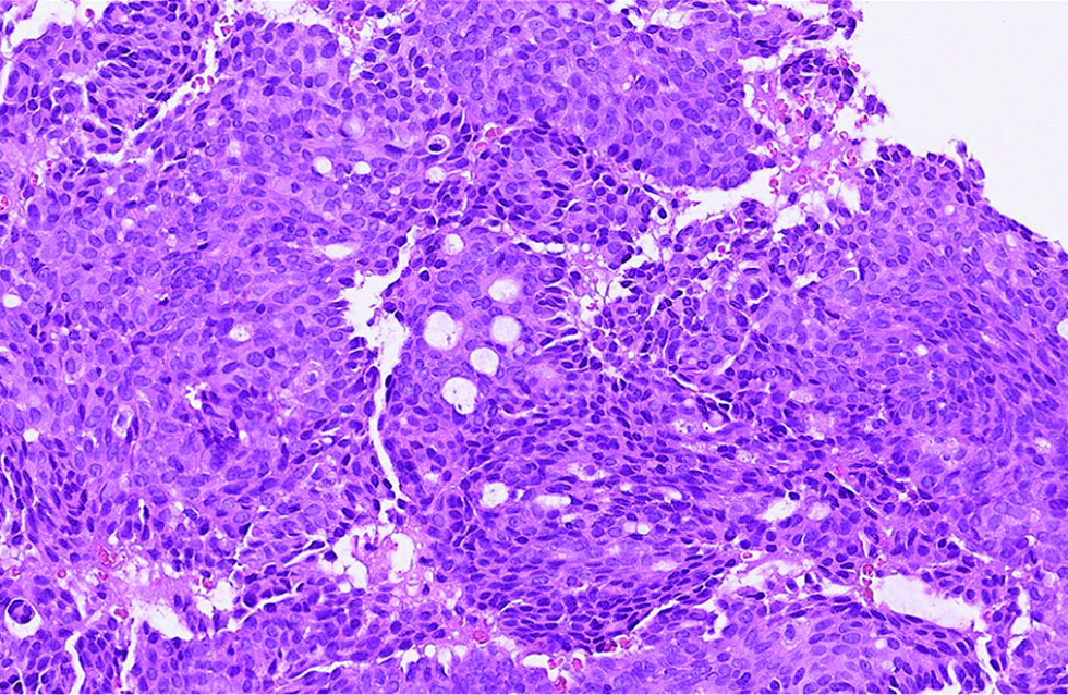 The tumour cells with round, ovoid to spindled nuclei, with stippled chromatins and occasional rosette-like arrangements in the first case (hematoxylin and eosin, ×600)