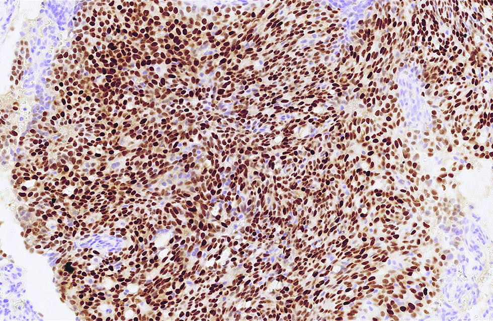 Crisp nuclear expression of insulinoma-associated protein 1 was detected in more than 95% of tumour cells in the first case (immunohistochemistry, ×500)