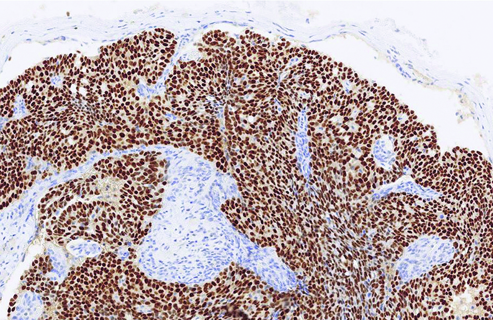 The tumour with strong and diffuse immunoreactivity to estrogen receptor in the first case (immunohistochemistry, ×400)