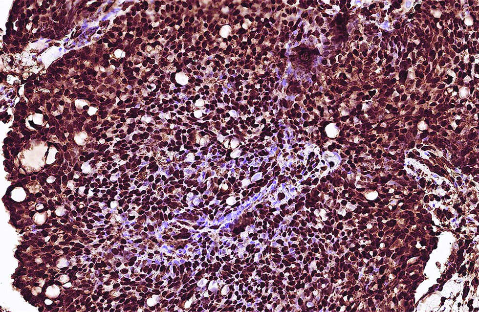 Robust positivity of Myb antibody was identified in the first case (immunohistochemistry, ×600)