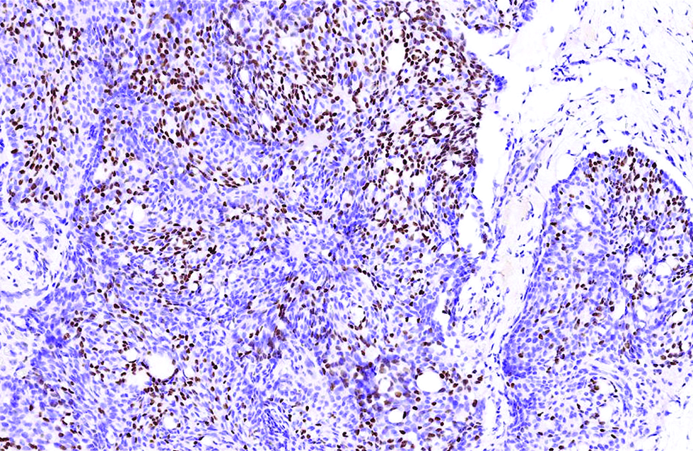 Staining of androgen receptor was relatively patchy but distinct, in 30% of tumour cells in the first case (immunohistochemistry, ×400)