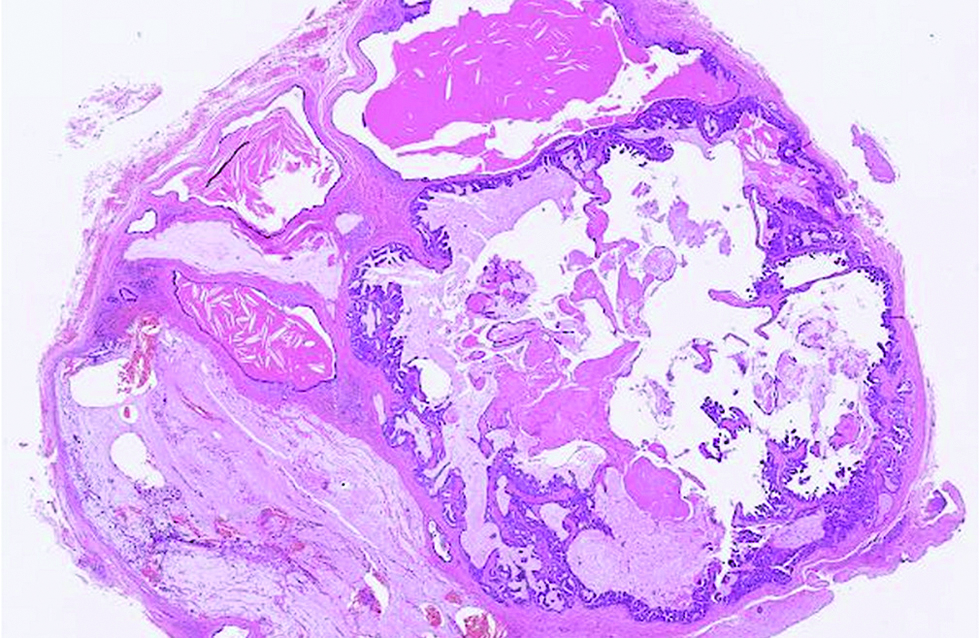 The tumour predominantly cystic and filled with mucin in the second case (hematoxylin and eosin, ×25)