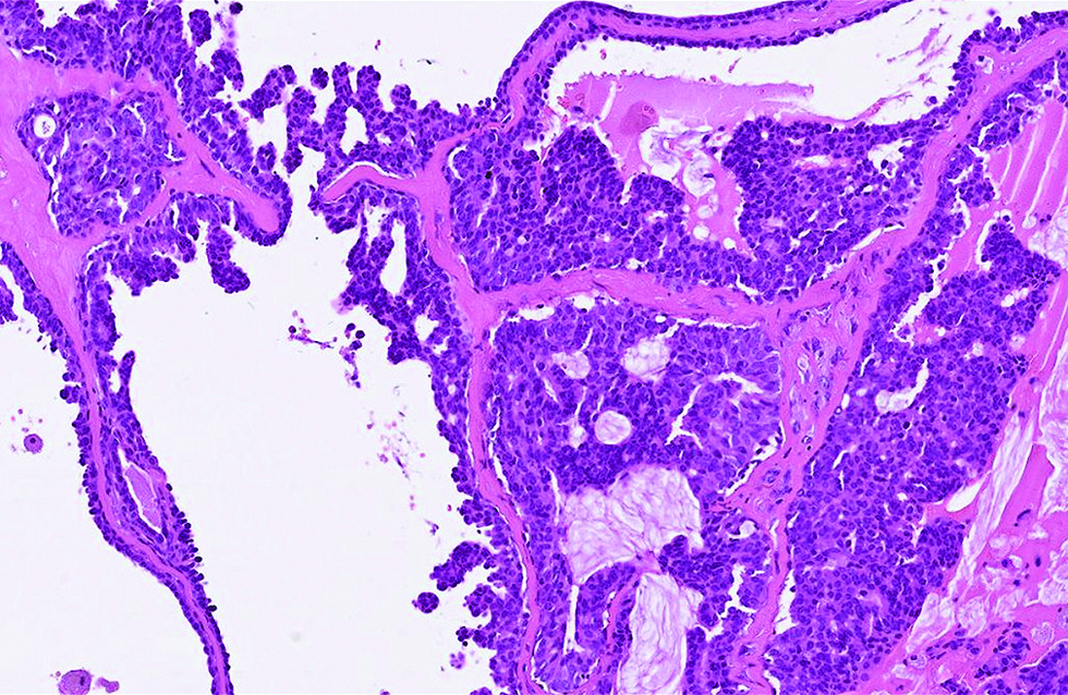 Tumor cells harboured pinkish cytoplasm with occasional apical snouts, and proliferated as papillary and micropapillary projections separated by hyalinized stroma in the second case (hematoxylin and eosin, ×400)