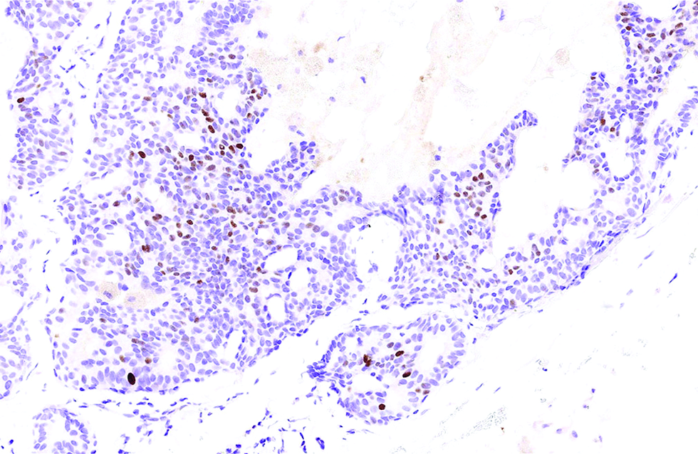 A small portion (15%) of tumour cells immunoreactive to insulinoma-associated protein 1 in the second case (immunohistochemistry, ×500)