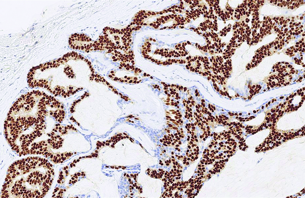 The staining pattern of estrogen receptor strong and diffuse in the second case (immunohistochemistry, ×400)