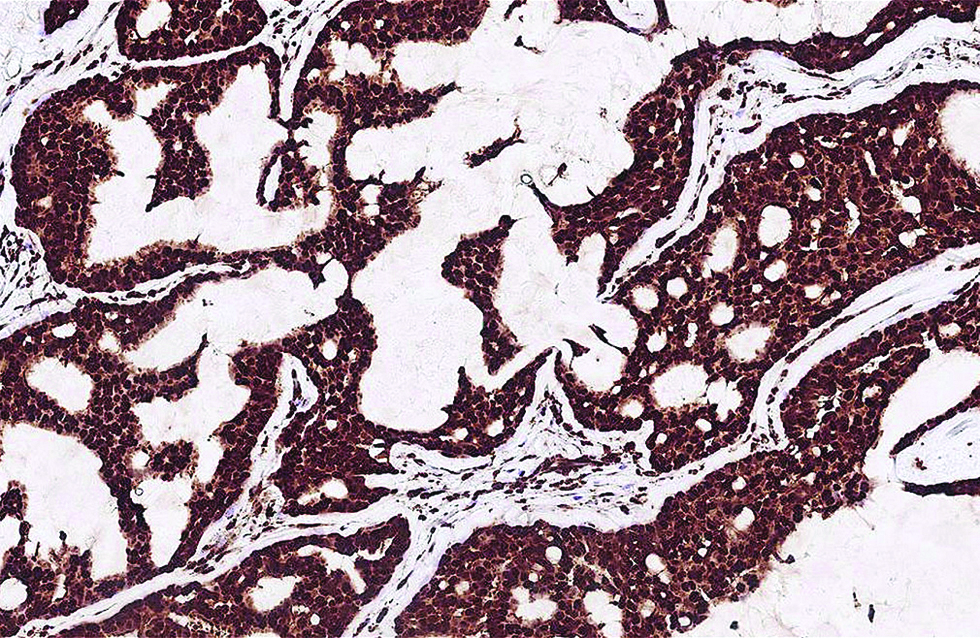 Distinct nuclear expression of Myb antibody in more than 95% of tumour cells in the second case (immunohistochemistry, ×400)