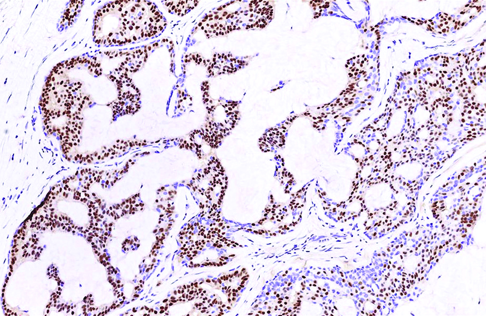 Androgen receptor stained about 70% of tumour cells and spared the myoepithelial cells in the second case (immunohistochemistry, ×400)