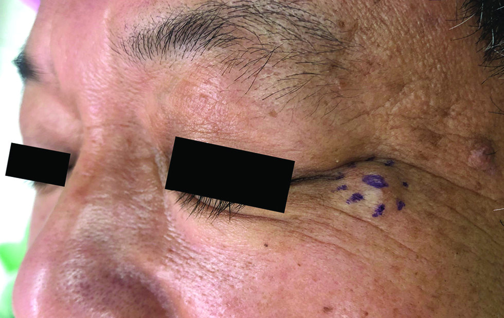 The smooth, skin-coloured nodule located at the left lateral canthal area in the third case