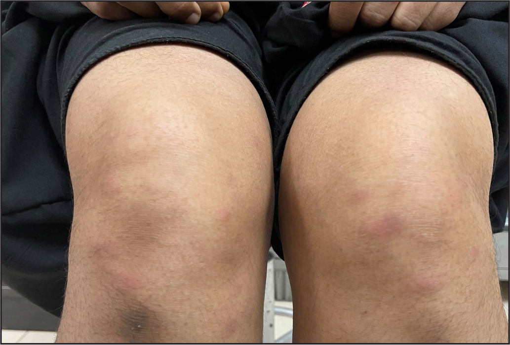 Multiple well-defined, bilaterally symmetrical erythematous papules and plaques present over the knees