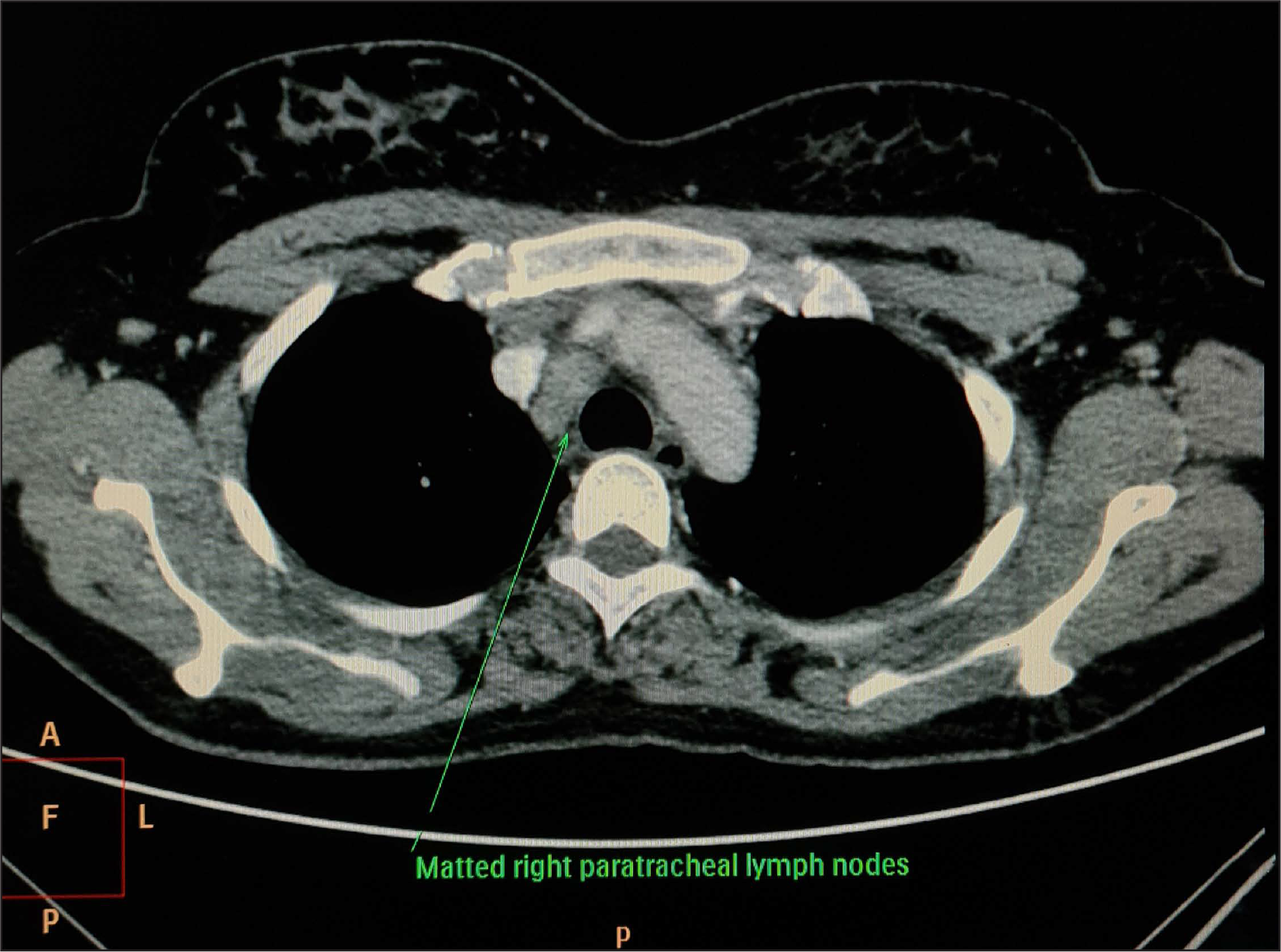 Computed tomography scan of the chest showing mediastinal lymphadenopathy