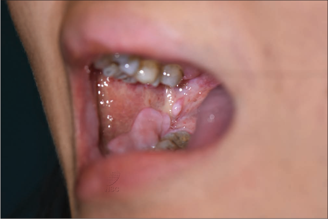 Extensive erosions over bilateral buccal mucosa