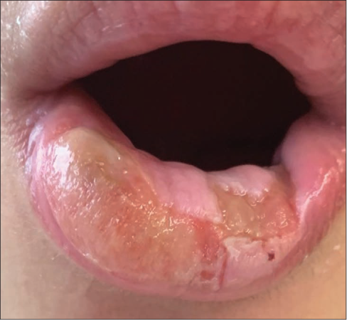 Multiple lower lip ulcers, coalescing in some areas, with active raised borders