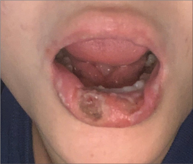 Persistent recurring lower lip ulcers coalescing in some areas