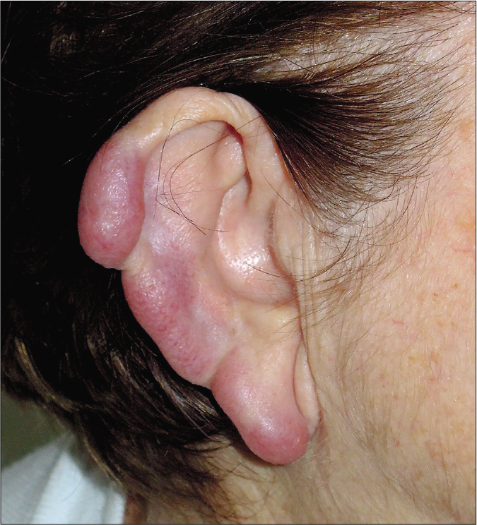 Right ear. Plum-colored nodules with partial destruction of the auricular cartilage