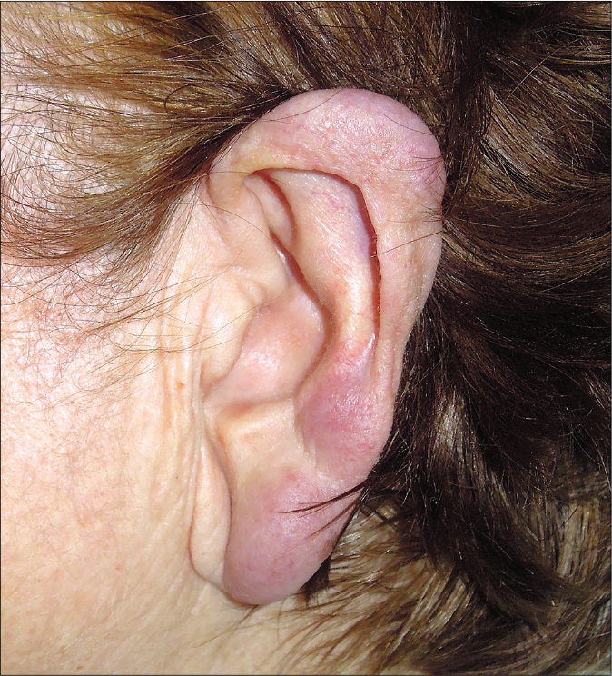 Left ear. Multiple erythematous to violaceous nodules