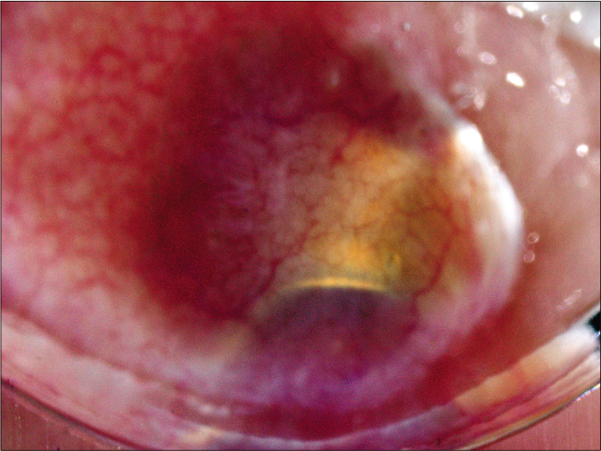 Dermatoscopic view of the nodule of left ear lobe