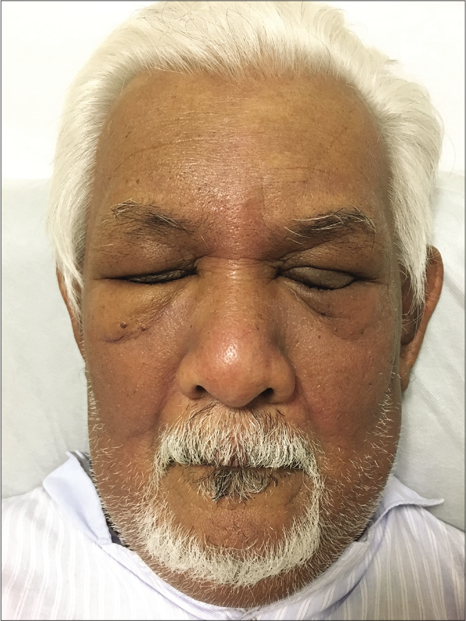 Generalized symmetrical swelling affected periorbital region, nose and cheeks, and barely perceptible violaceous erythematous patches on the glabella and nose