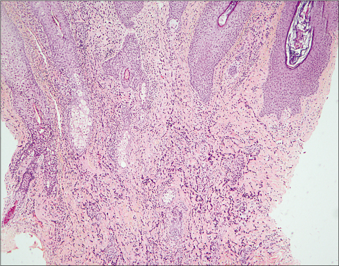 Histopathological examination of a skin biopsy specimen taken from the left cheek. The dermis is extensively infiltrated by spindle cell proliferation, extending deeply and surrounding adnexal structures (H and E, ×40)