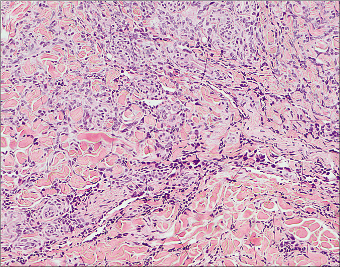 Histopathological examination of a skin biopsy specimen taken from the left cheek. Spindle cells contain pleomorphic and hyperchromatic nuclei. They enclose numerous irregular slit-like vessels that dissect between collagen bundles (H and E, ×100)