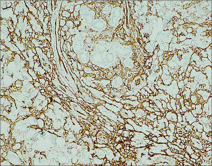 Histopathological examination of a skin biopsy specimen taken from the left cheek. Neoplastic cells are positive for CD31 (×100)