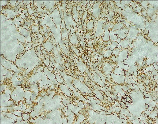 Histopathological examination of a skin biopsy specimen taken from the left cheek. Neoplastic cells are positive for podoplanin (×100)