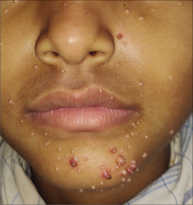 BOTE sign in molluscum contagiosum