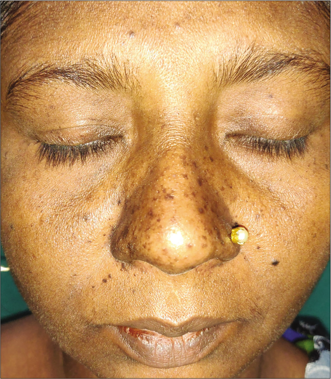 Centrofacial distribution of pigmentation (chik sign) in a patient of chikungunya