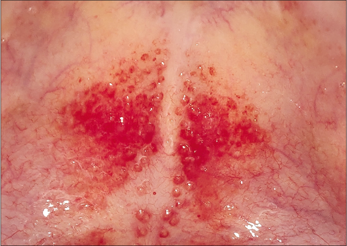 Erythematous papules with pale center (doughnut sign) in Group A streptococcal pharyngitis