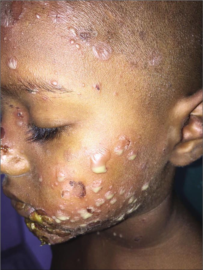 Hypopyon sign in bullous impetigo (Courtesty- Dr. Abdul Sahid Khan, Department of Dermatology, SCB Medical College, Cuttack, Odisha)