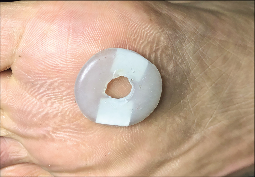 Disc affixed over lesion by means of double-sided adhesive tape