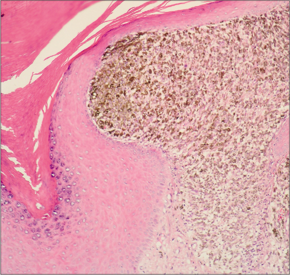 Acral lentiginous melanoma, showing epidermis with acanthosis, in papillary dermis atypical melanocytes with melanin granules and large nuclei. (H&E, ×100)