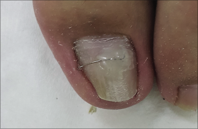 A patient with chronic dystrophic ingrown toenails and was treated with COMBIped® nail braces