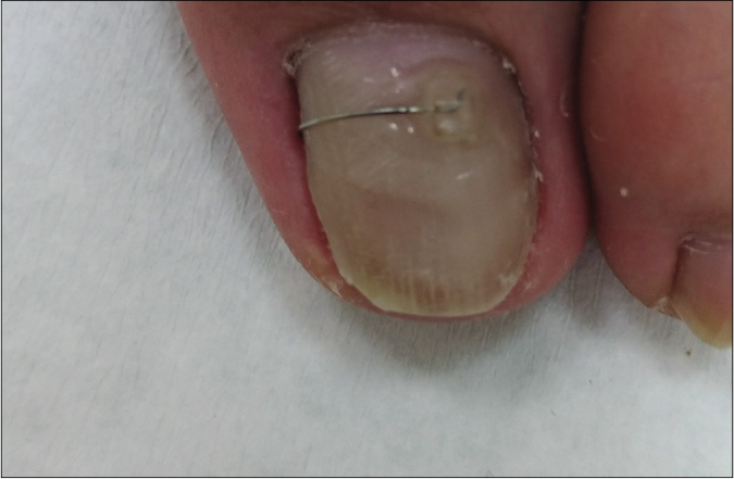 The patient was treated for 8 months and the ingrown toenails significantly improved