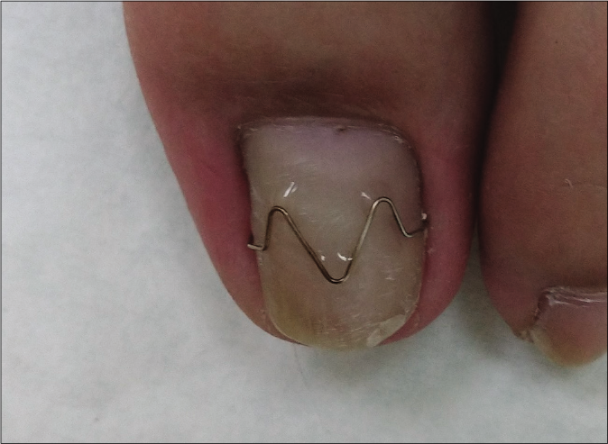 One year after removal of COMBIped® nail braces, ingrown toenails recurred and he was then treated with Naspan® nail braces