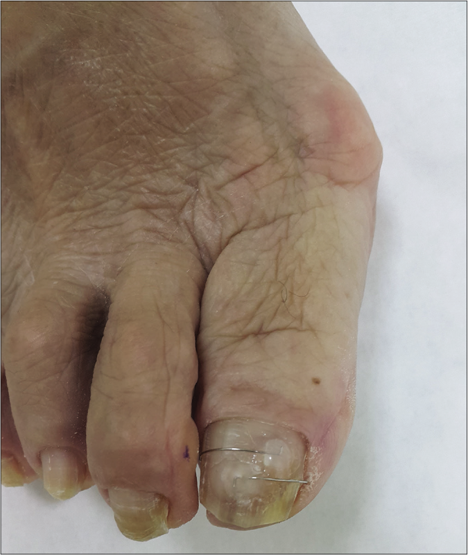 A patient with severe hallux valgus who has been treated with COMBIped® nail brace but with recurrence one year later