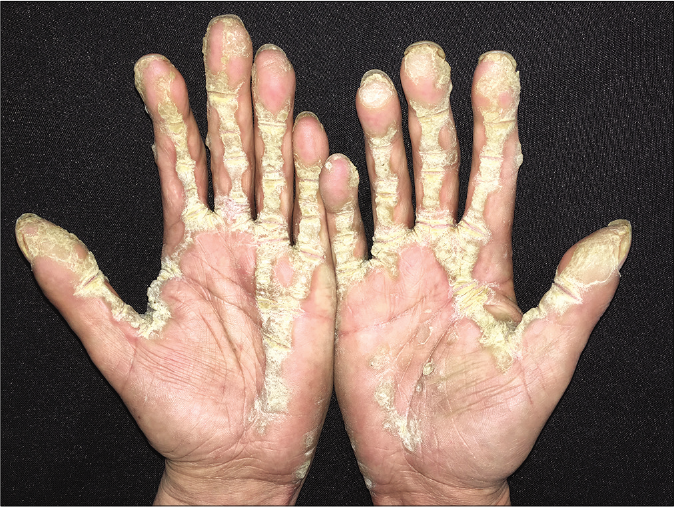 Symmetrically distributed, linear hyperkeratosis on the flexor aspect of the fingers, the area of the right palm between the 1st and 2nd fingers and the hypothenar region of the left palm