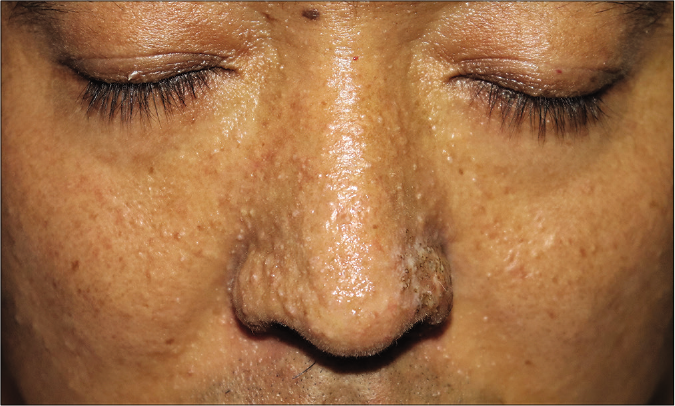 Small (<2 mm in diameter) skin-colored papules were symmetrically distributed on the nose and cheek